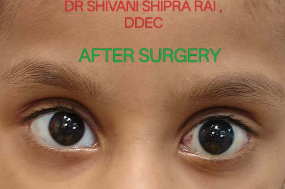 Squint treatment after image