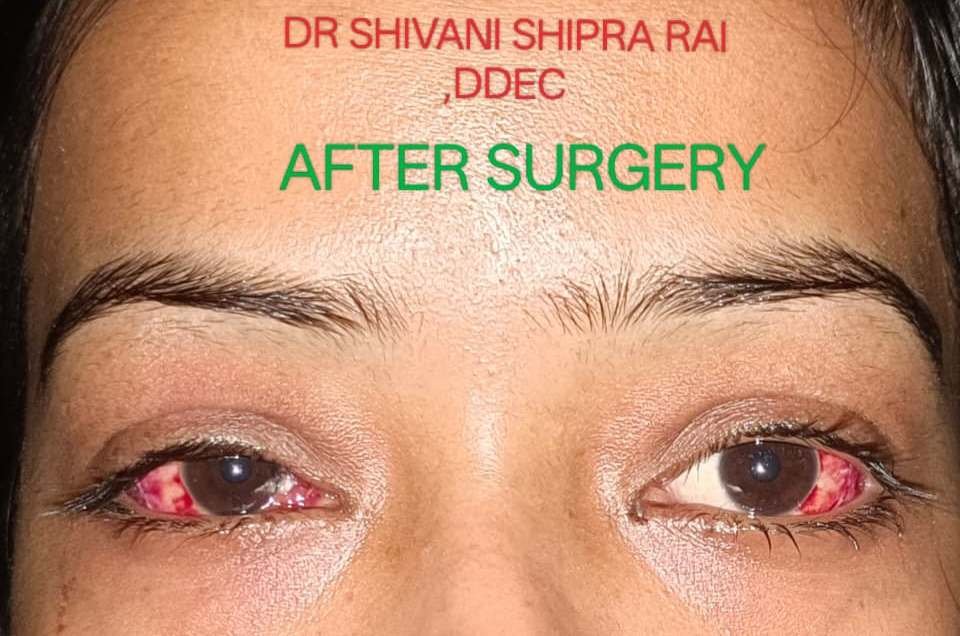 Squint treatment after image
