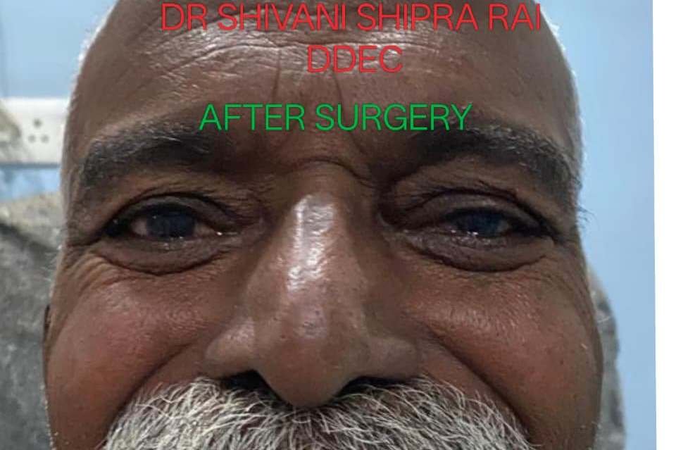 Squint treatment after image
