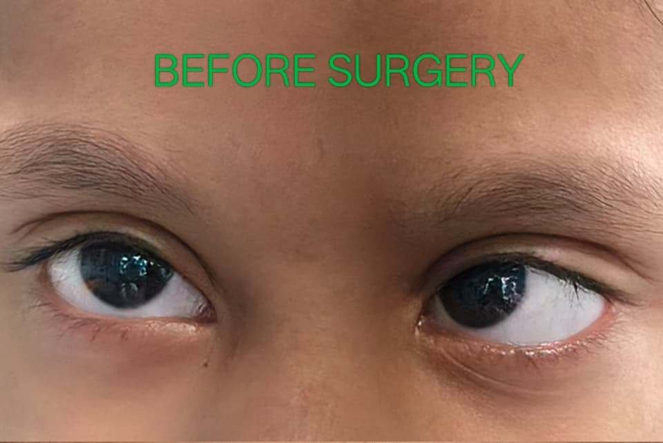 Squint treatment before image