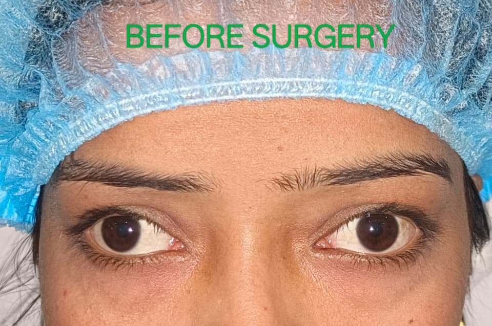 Squint treatment before image