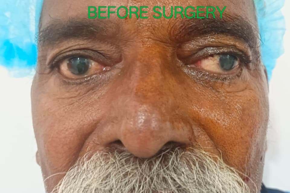 Squint treatment before image